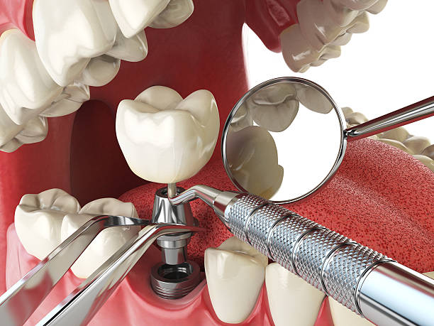 Best Knocked-Out Tooth (Avulsed Tooth) Treatment in Paisley, FL