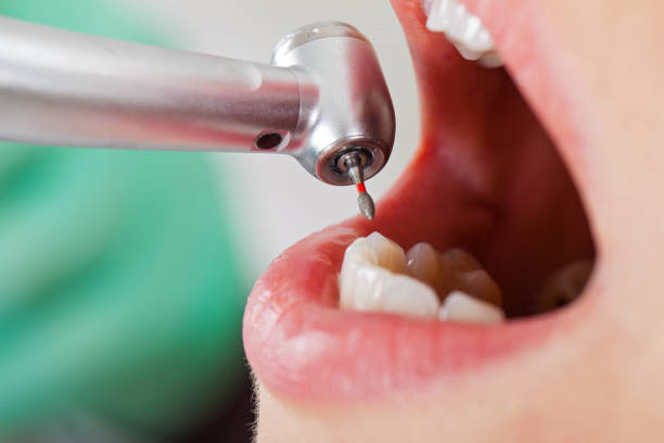 Best Lost Filling or Crown Replacement in Paisley, FL